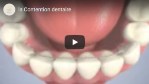 La Contention dentaire